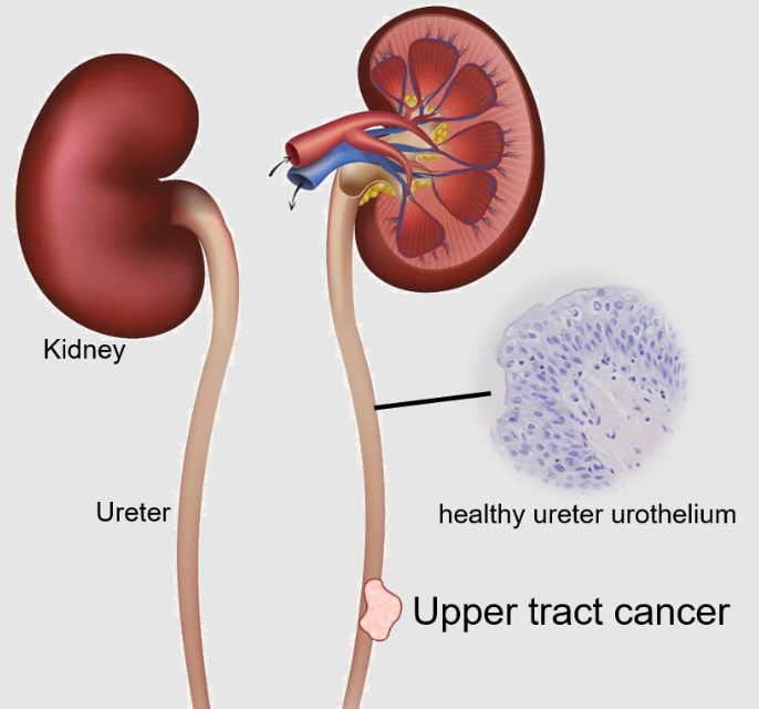 Utuc Presentation Upper Tract Urothelial Cancer (UTUC) | The Urology Institute